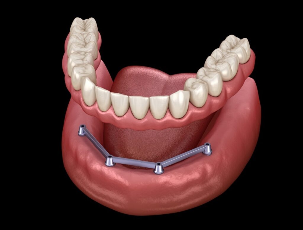 BAR-SUPPORTED DENTURE