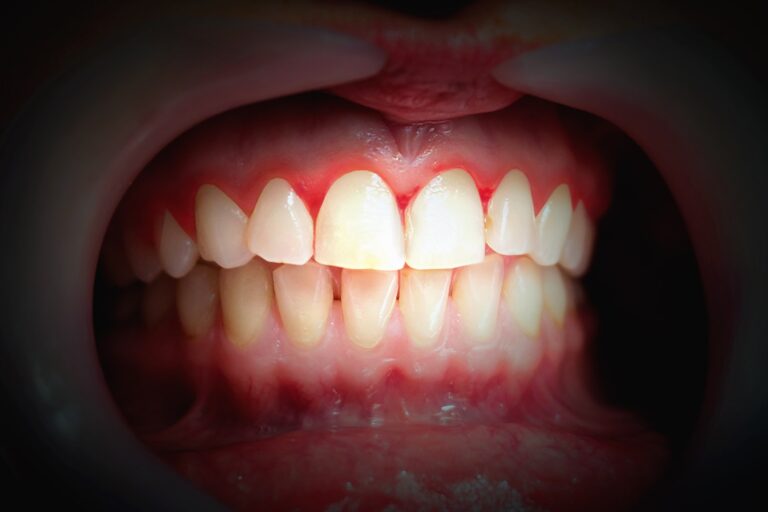 Bleeding gums – a common disease