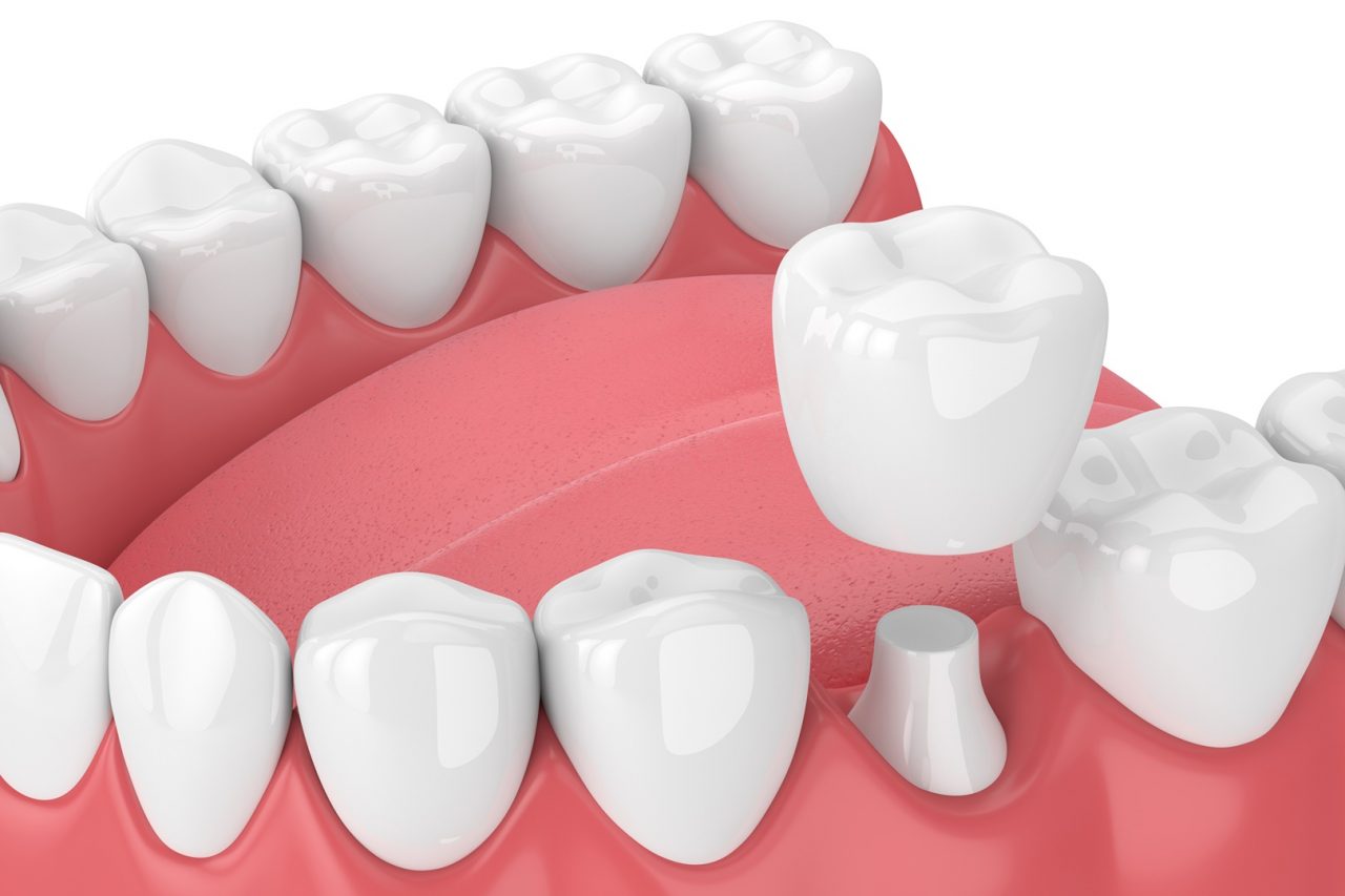 Evergreen Dental crowns and bridges