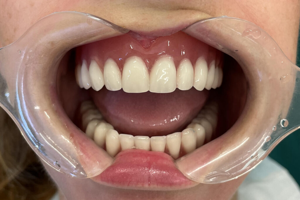 Bar supported denture 4 Implantaten