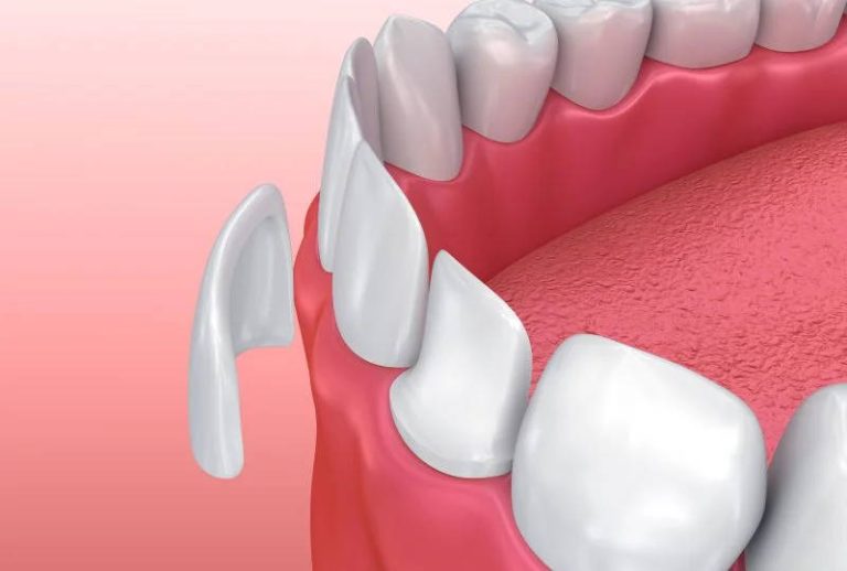 All about Veneers